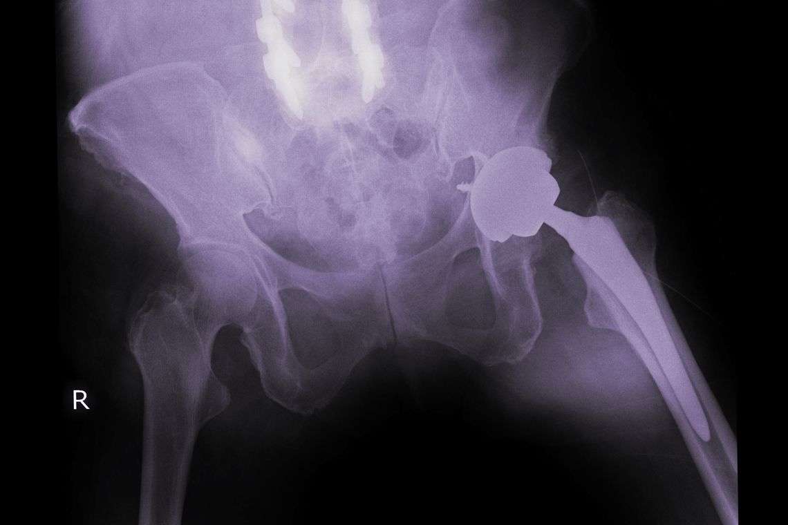 Bone Cement Lawsuit Hero Image